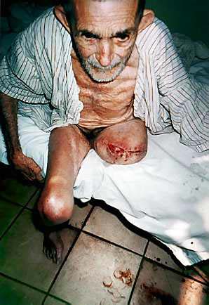 Anciano con herida mal suturada y s�ntomas de desnutrici�n, los servicios hospitalarios cubanos son precarios pese a los subsidios sovi�ticos y ayudas internacionales